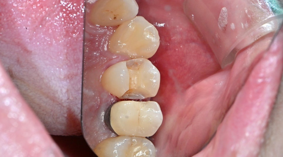 마곡동치과_당일 인레이 치료 과정 관련 이미지 4