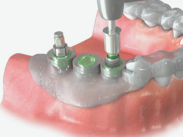 마곡치과_"CT 분석부터 가이드 제작까지!"[2. 3D 네비게이션 임플란트 진행과정] 관련 이미지 4