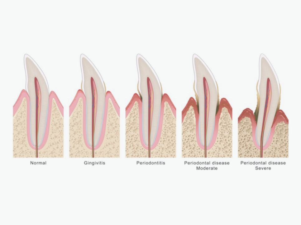 마곡동치과_ 1. 치석 제거는 기본! 스케일링 효과 5가지 총정리 관련 이미지 2