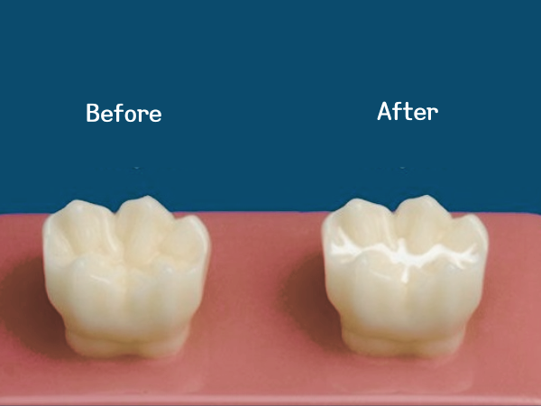 Maggok Station Dental Clinic_ “When Is the Right Time?” [2. Timing and Cost of Pit and Fissure Sealants] image 4