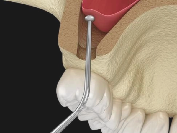 마곡동치과_&ldquo;왜 가격이 다를까?&rdquo;[4. 3D 네비게이션 임플란트 비용과 보험 그리고 선택기준] 관련 이미지 3
