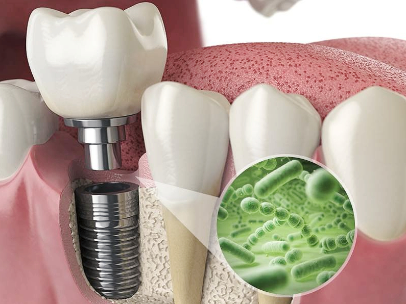 마곡동치과_&ldquo;양치했는데 왜?&rdquo; 숨은 이유 공개! [ 2. 임플란트 주위염 원인 ] 관련 이미지 1