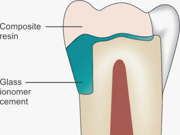 마곡역치과_ 1. 글래스아이오노머(GI) 특징과 장단점 관련 이미지 6