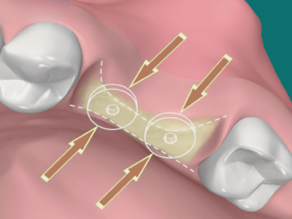 마곡동치과_1. 임플란트 치료에 관련 이미지 8