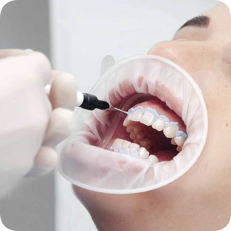 마곡동치과_전문가 미백 관련 이미지 4