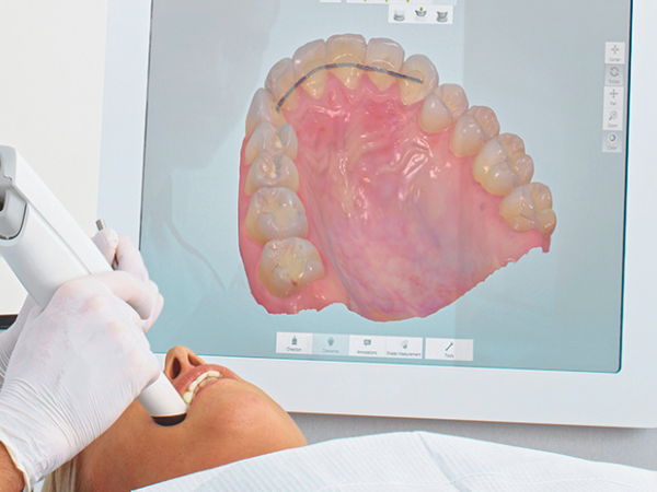 마곡동치과_ &ldquo;이럴 때 치아 본을 떠야 합니다!&rdquo; [2. 인상채득이 필요한 경우] 관련 이미지 4