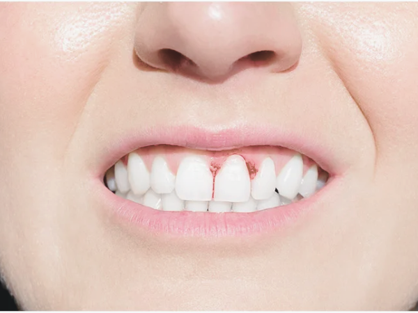 마곡역치과_&ldquo;괜찮겠지?&rdquo; 방심하다가 큰일! [ 1. 임플란트 주위염 3가지 증상 ] 관련 이미지 3