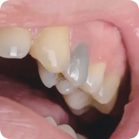 마곡역치과_ 하얀 이가 누렇게 변했다? [ 1. 치아변색의 원인 ] 관련 이미지 8