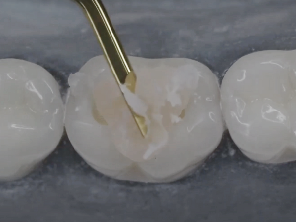 마곡동치과_3. 인레이 치료 과정과 소요 시간 (feat. 저스트 스캔) 관련 이미지 4