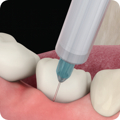 마곡동치과_&ldquo;지금도 늦지 않았다!" [ 4. 임플란트 주위염 치료법 ] 관련 이미지 2