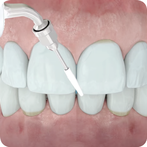 마곡역치과_&ldquo;치아가 개운해지는 6단계 여정&rdquo; [ 4.  에어플로우 스케일링 과정 ] 관련 이미지 6