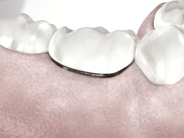 마곡역치과_5. 크라운 보철물 손상과 탈락, 원인과 치료 관련 이미지 1