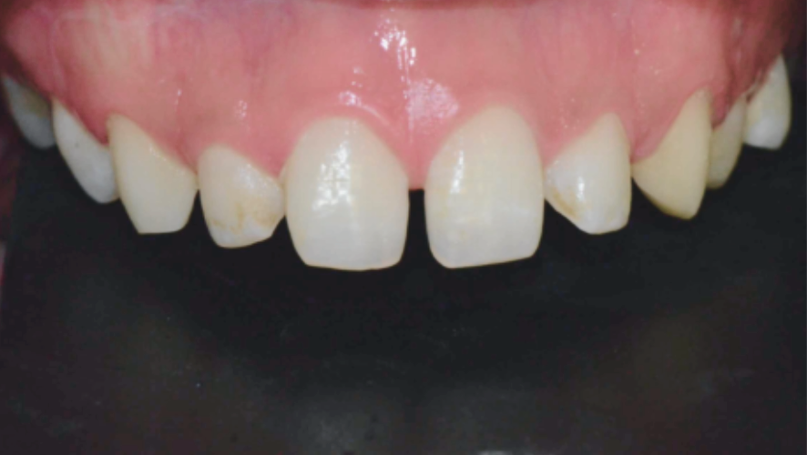 마곡역치과_3. 무삭제 라미네이트(디아네이트) 시술 과정 관련 이미지 1