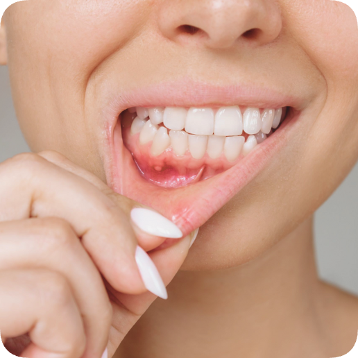 마곡동치과_ "자연치아 지키는 골든타임" [ 1. 신경치료 꼭 받아야 하는 5가지 경우 ] 관련 이미지 5