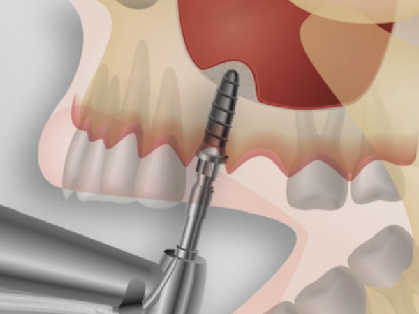 마곡동 치과_2. 상악동거상술 위험한가요? 부작용 현실 기준 정리 관련 이미지 1