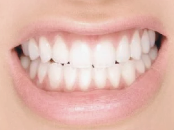 마곡역치과_5. 브릿지 치료 후 관리 방법, 오래 쓰기 위해 꼭 챙겨야 할 것들 관련 이미지 4