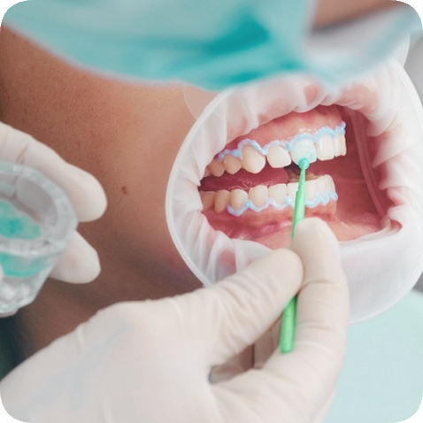 마곡동치과_전문가 미백 관련 이미지 5