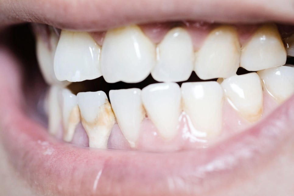 마곡역치과_ 1. 스케일링 꼭 받아야 하나요? 치석 제거부터 잇몸병 예방까지 효과 총정리 관련 이미지 2