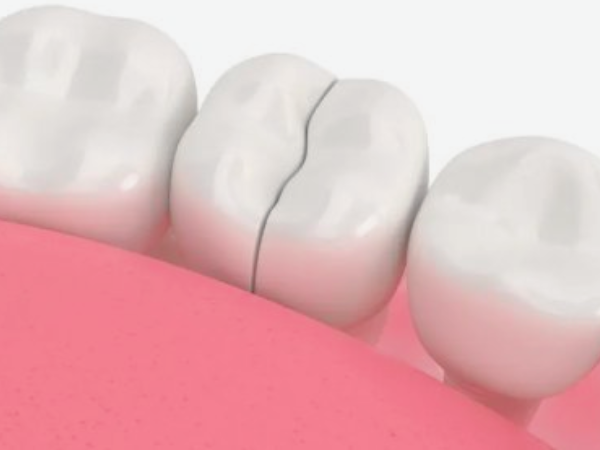 마곡역치과_ &ldquo;얼음물 한 모금에 찌릿?&rdquo;[1. 치수염 원인과 증상] 관련 이미지 2