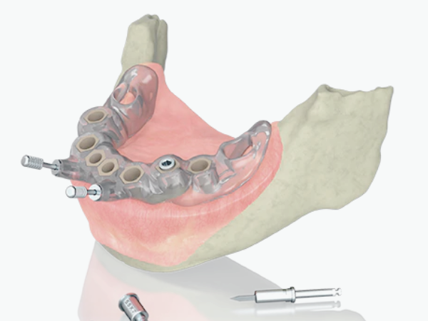 마곡치과_"기존 임플란트와 뭐가 다른가요" [1.3D 네비게이션 임플란트 기본] 관련 이미지 4