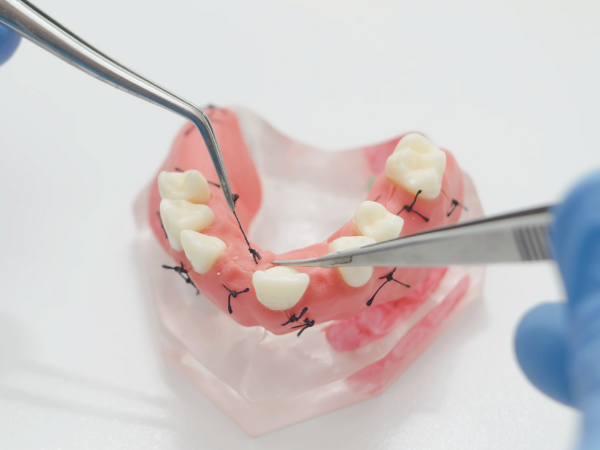 Magok Station Dental Clinic_7. Suture Removal Timing and Care After Implant Surgery image 2