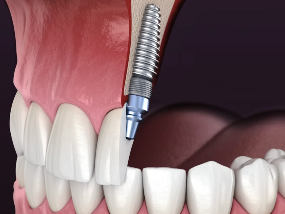마곡역치과_2. 스케일링 주기, 얼마나 자주 받아야 할까? 소요시간까지 총정리 관련 이미지 5
