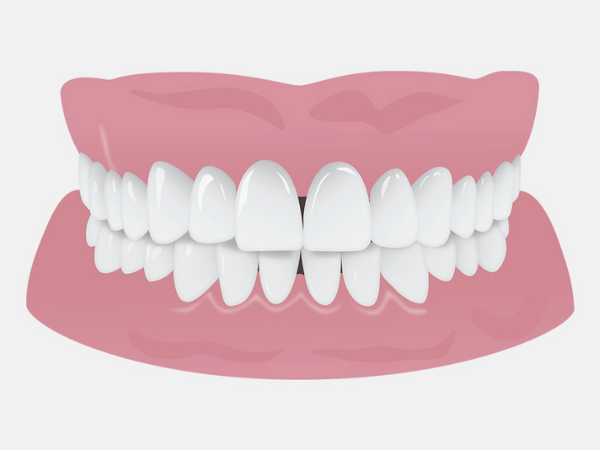 마곡동치과_4. 스케일링 오해와 진실? 치아 깎인다? 시리다? 진짜는 따로 있습니다. 관련 이미지 3