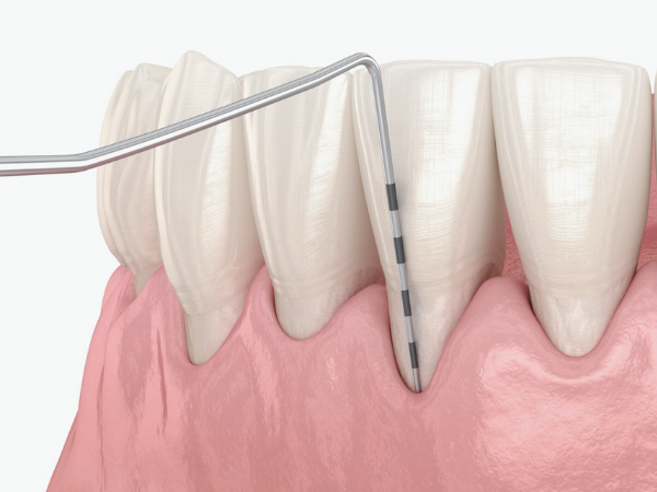 마곡동치과_&ldquo;내려가기 전에! 잇몸을 지키는 진짜 방법 7가지&rdquo;[5. 치은퇴축 예방법] 관련 이미지 1