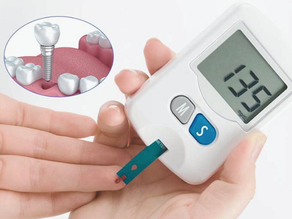 마곡동치과_ "오늘 뽑고 심는 임플란트, 정말 괜찮을까?" [ 2. 당일 임플란트 장점 단점 ] 관련 이미지 8