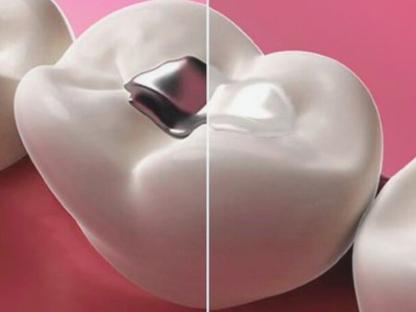 마곡역치과_3. 아말감 왜 검게 변할까요? 충치 신호인지 아닌지  알려드립니다 관련 이미지 2