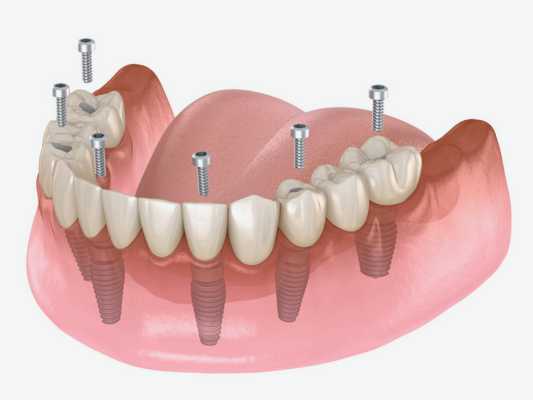 Magok-dong Dental Clinic_2. How Is It Different from Dentures? 5 Advantages of Full-Arch Implants image 2