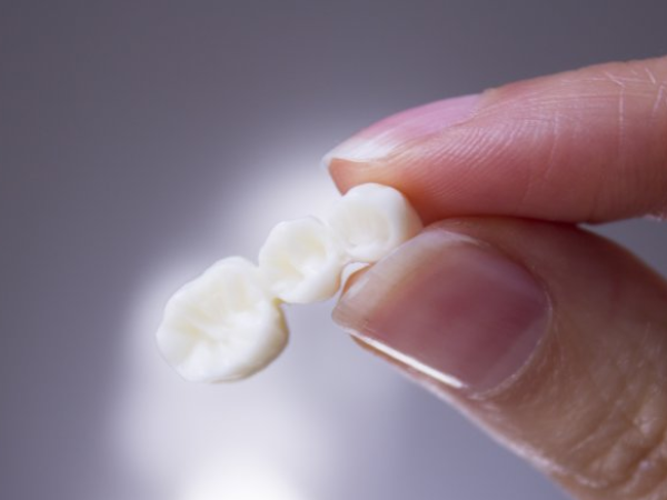 마곡동치과_3. 브릿지 치료는 어떻게 진행될까요? 실제 과정 순서대로 정리 관련 이미지 4