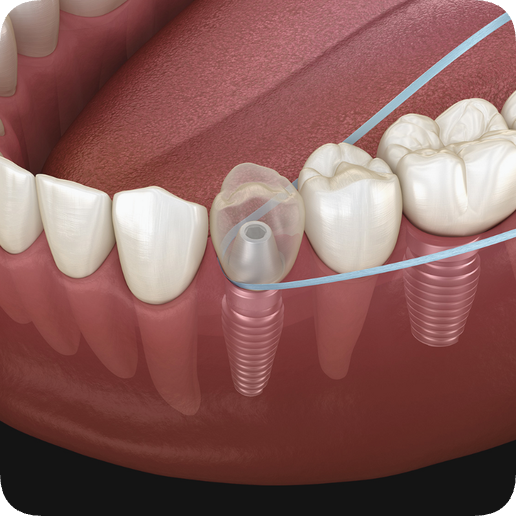 마곡역치과_&ldquo;예방이 최고의 치료다!&rdquo;[  5. 임플란트 주위염 예방법 ] 관련 이미지 1