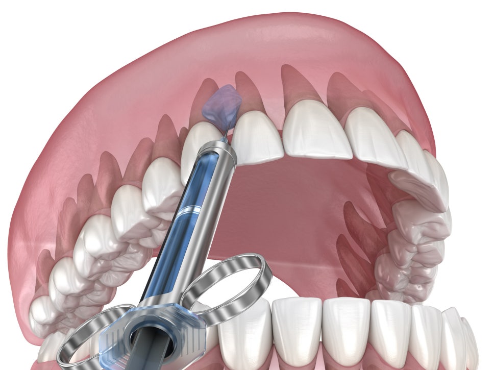 마곡동치과_3. 잇몸재생주사 PDRN 시술 과정, 통증, 안전성 총정리 관련 이미지 5