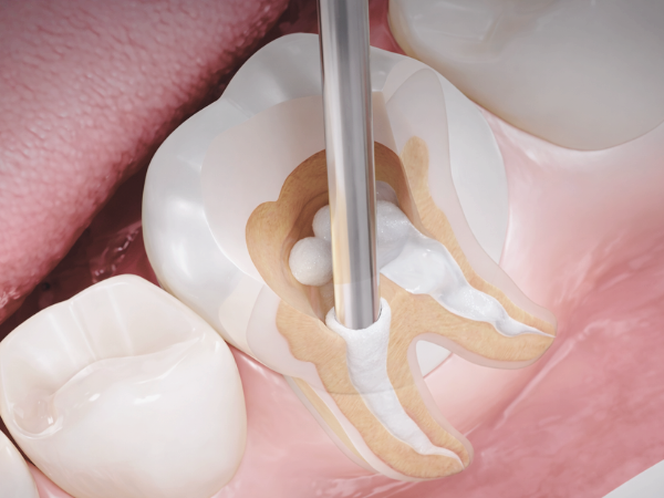 마곡치과_3. 재신경치료 과정, 신경치료 후 다시 아플 때 어떻게 진행될까요? 관련 이미지 4