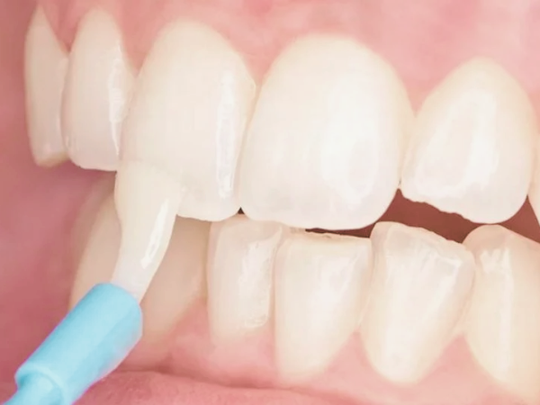 마곡역치과_&ldquo;바니시, 이렇게 진행됩니다!&rdquo; [3. 치과 불소도포 과정] 관련 이미지 3