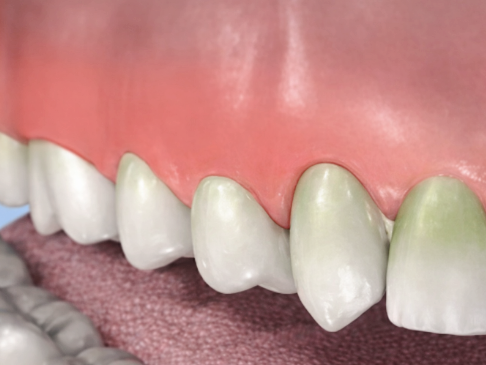 마곡치과_1. 씹을 때 치아 통증, 왜 생길까요? 관련 이미지 4