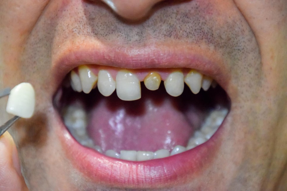 [ Magok Veneers_07 ] Veneer Failure Cases: Be Careful in These Situations image 4