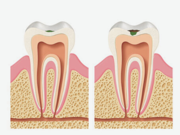 마곡역치과_ 2. 글래스아이오노머(GI) 적응증 관련 이미지 1