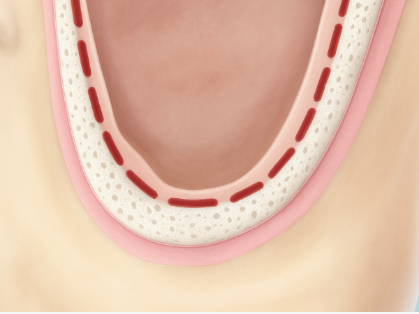 마곡치과_3. 상악동 거상술 측방 접근법, 언제 어떻게 진행될까? 관련 이미지 2