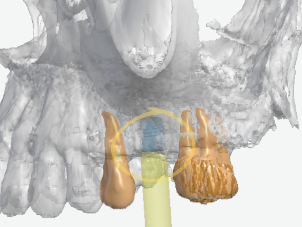 마곡동치과_1. 상악동거상술 꼭 해야 하나요? 안 하면 생기는 문제 관련 이미지 5