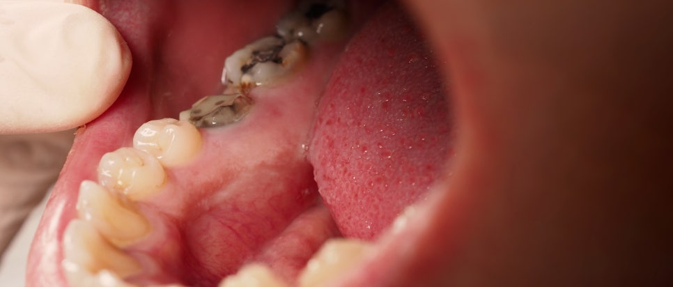 Mokgok Station Dental Clinic_6. Why cavities can come back after treatment, and what to do to prevent recurrence image 1