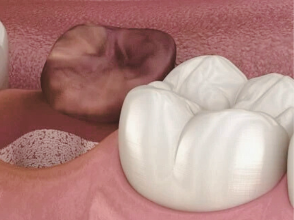 마곡동치과_7. 사랑니 발치 후 생기는 드라이소켓, 원인과 증상부터 예방법까지 총정리 관련 이미지 2