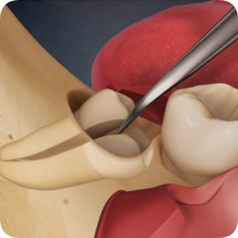 마곡동치과_10. 사랑니 발치 비용, 진짜 얼마일까요? 건강보험 적용으로 부담 덜어드립니다! 관련 이미지 4