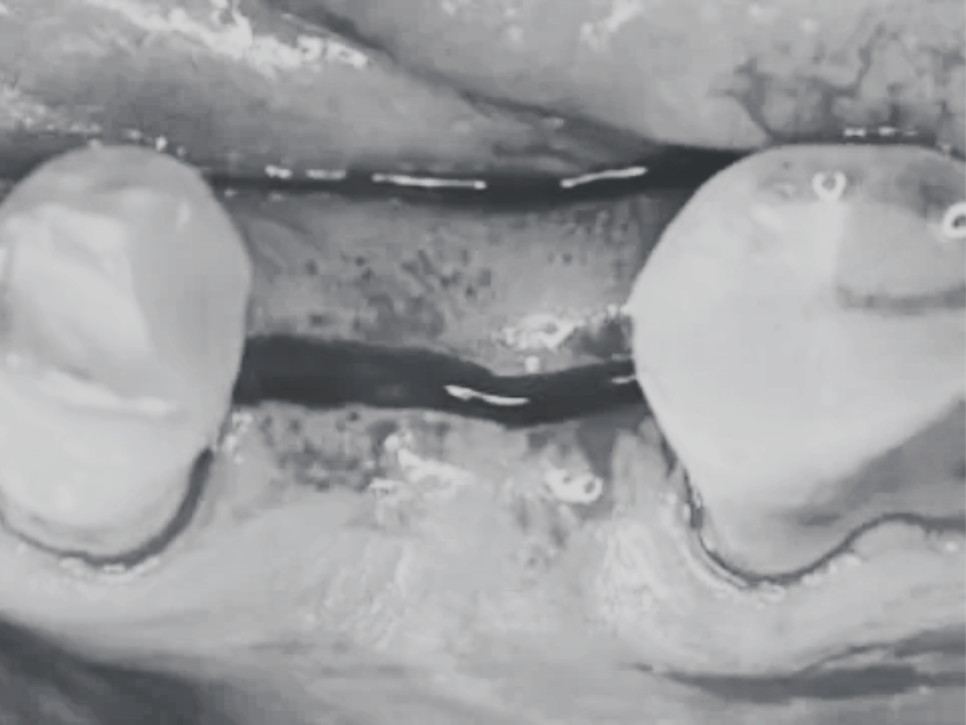 마곡역치과_"내 치아를 지키는 가장 스마트한 선택" [ 4. 임플란트 장점과 단점 ] 관련 이미지 6