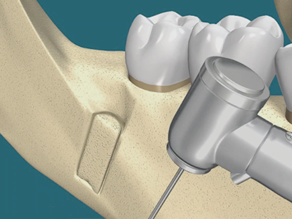 마곡동치과_2. 임플란트 뼈이식에 사용되는 재료의 모든 것 관련 이미지 1
