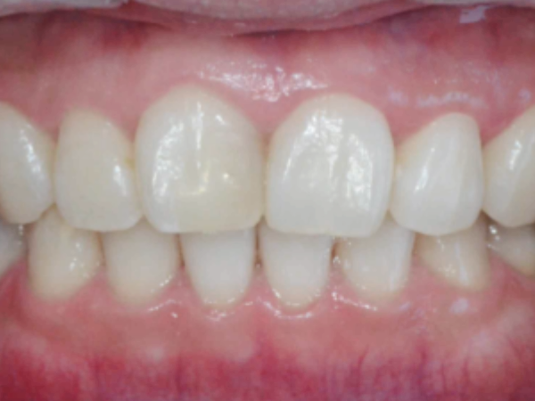 마곡역치과_3. 레진변색, 디아네이트 무삭제 라미네이트 케이스 관련 이미지 4