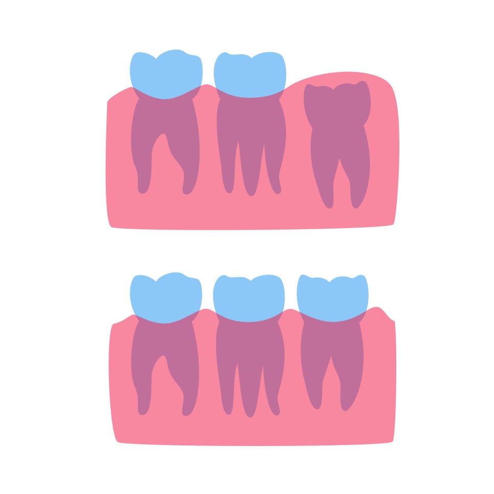 [ Magok Dental_01 ] Do wisdom teeth have to be removed no matter what? There are cases where extraction is not necessary image 2