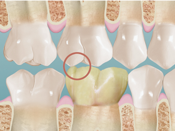 마곡역치과_&ldquo;겉은 멀쩡한데 왜 찌릿할까?&rdquo;  [1. 치아 금(균열) 생기는 이유 ] 관련 이미지 6