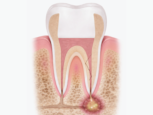 마곡치과_4. 신경치료 후 통증, 재신경치료와 발치 어떤 선택이 맞을까요? 관련 이미지 3
